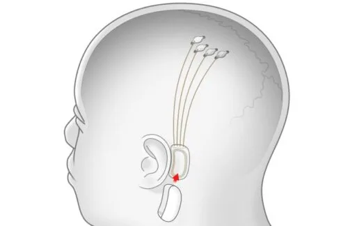 Projekt Neuralink Elona Muska – wkrótce dowiemy się o nim więcej